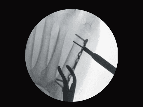 Авторегуляція на метал
Автоматичне розпізнавання металевих імплантів для подальшого налаштування параметрів отримання зображення.