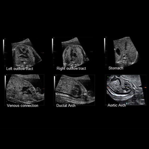 SonoVCADheart™
SonoVCADheart™ спрощує процес ультразвукової діагностики серцевих вад.
