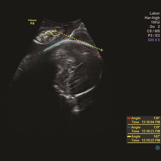 SonoVCADlabor™
Технологія SonoVCADlabor™ для візуалізації та аналізу процесу пологів.
