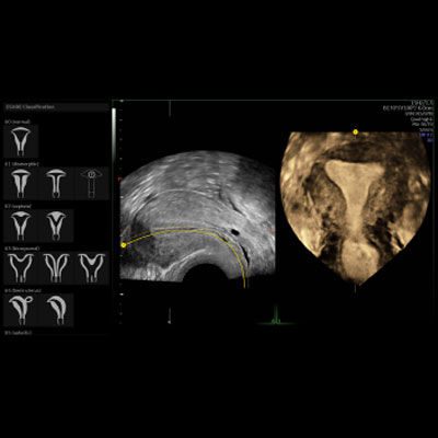 Uterine Trace

