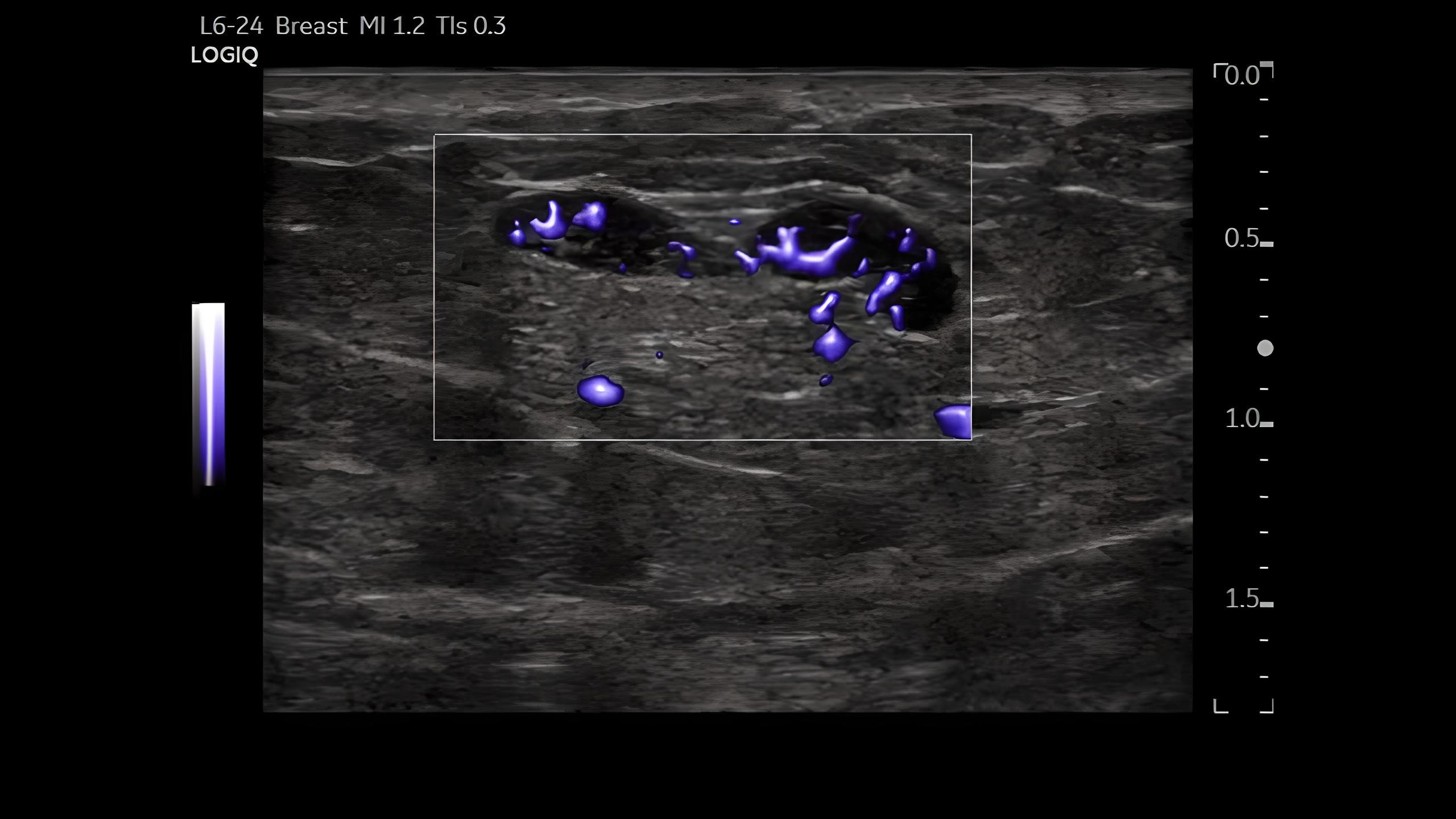 Micro Vascular Imaging of Breast Lesion, L6-24-D
Режим MVI, мікроваскулярізація, новоутворення.
