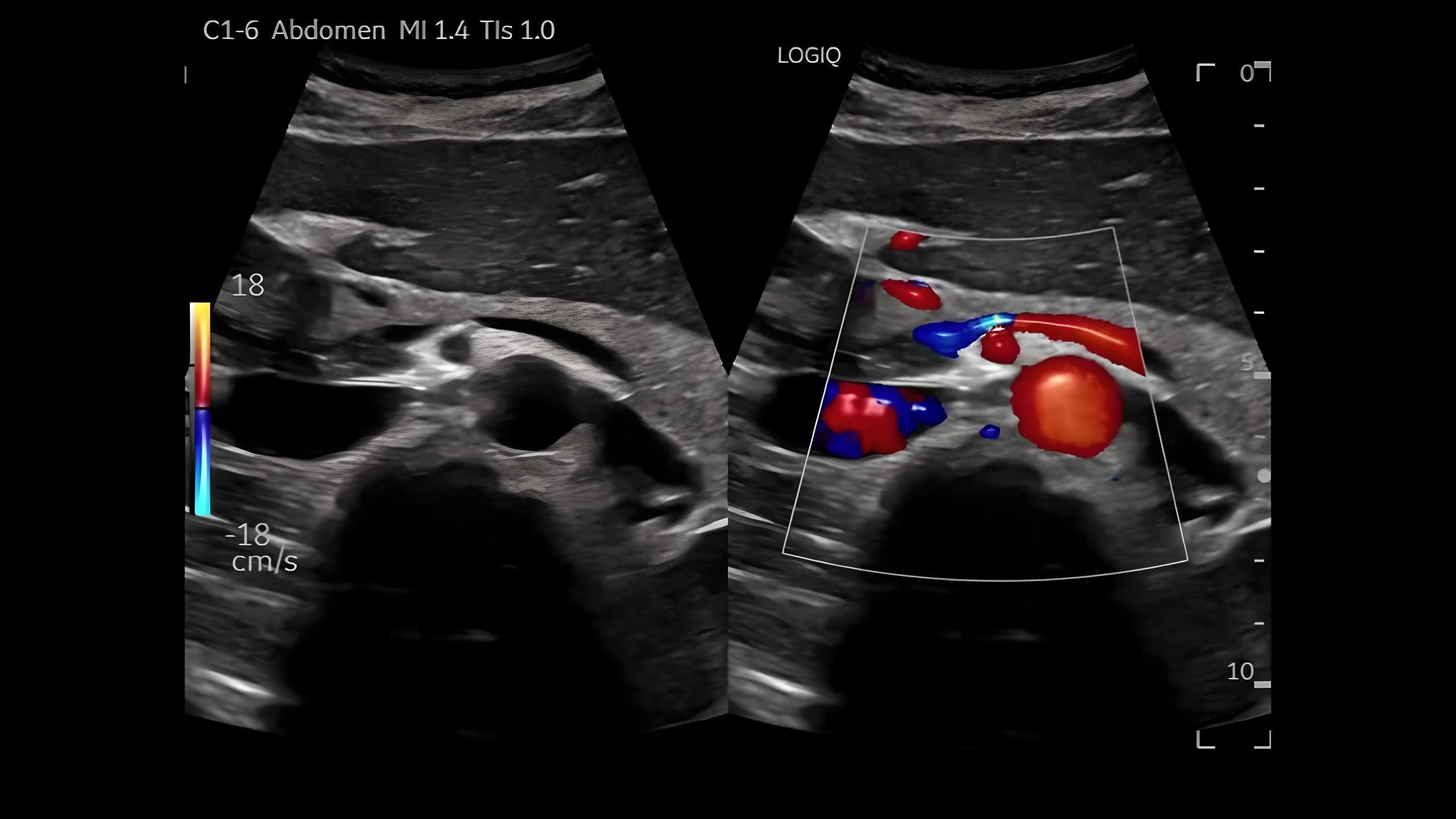 Dual Mode, Pancreas, C1-6-D
Режим подвійного екрану, підшлункова залоза.
