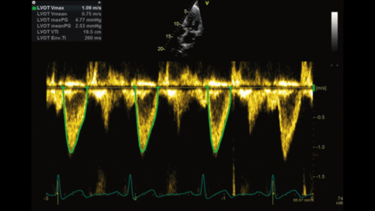 Cardiac Auto Doppler (AI)