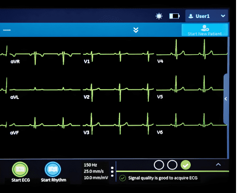 Передові алгоритми Critical Values та Acute Coronary Syndrome Analysis

Алгоритми Critical Values (алгоритм оцінки критичних значень) та Acute Coronary Syndrome Analysis (алгоритм аналізу гострого коронарного синдрому) дозволять під час збору даних ЕКГ виявити принаймні одну критичну зміну на ЕКГ та відобразити її у додатковому вікні в порядку значущості.
