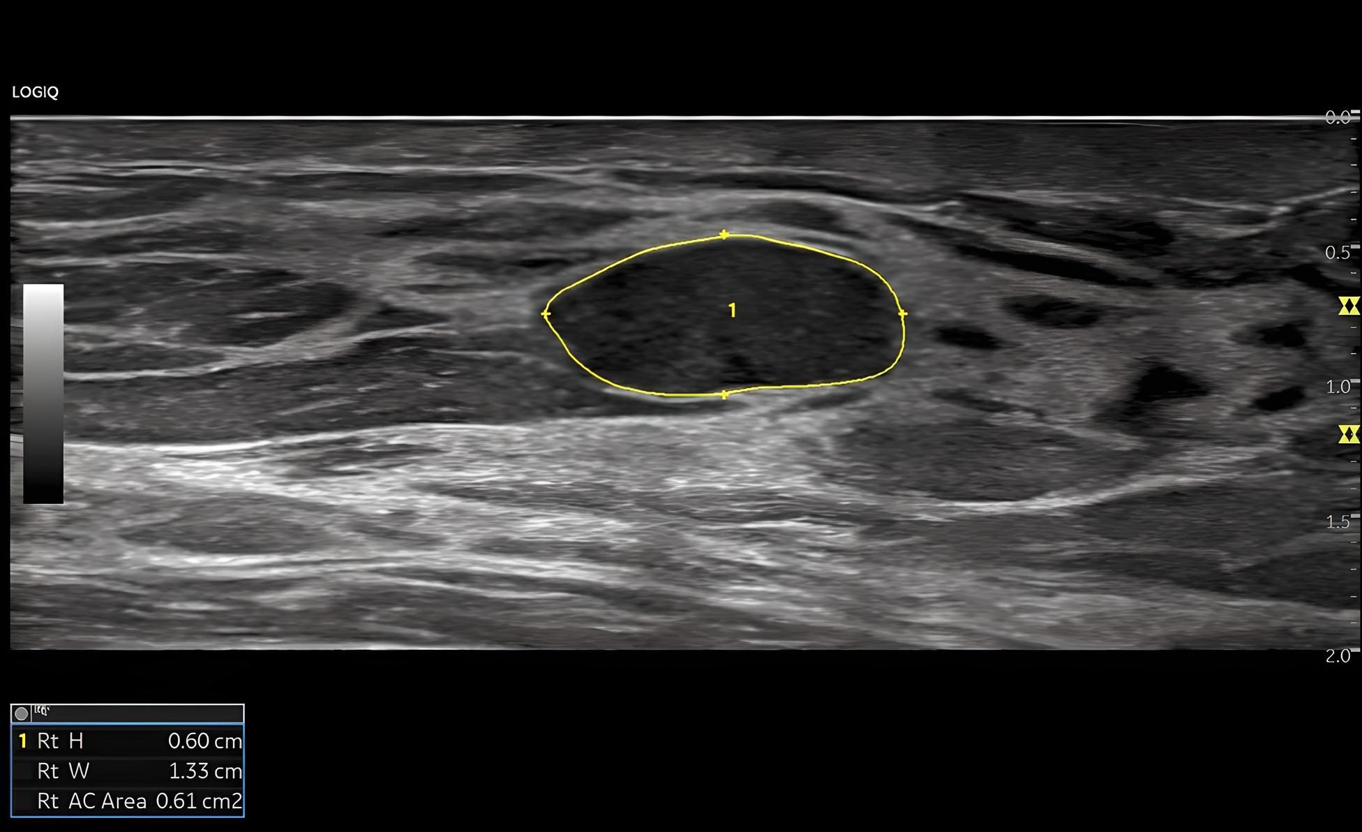 Auto Lesion Segmentation Breast, ML6-15-RS
Автоматичні вимірювання, ураження грудей, датчик ML6-15-RS.
