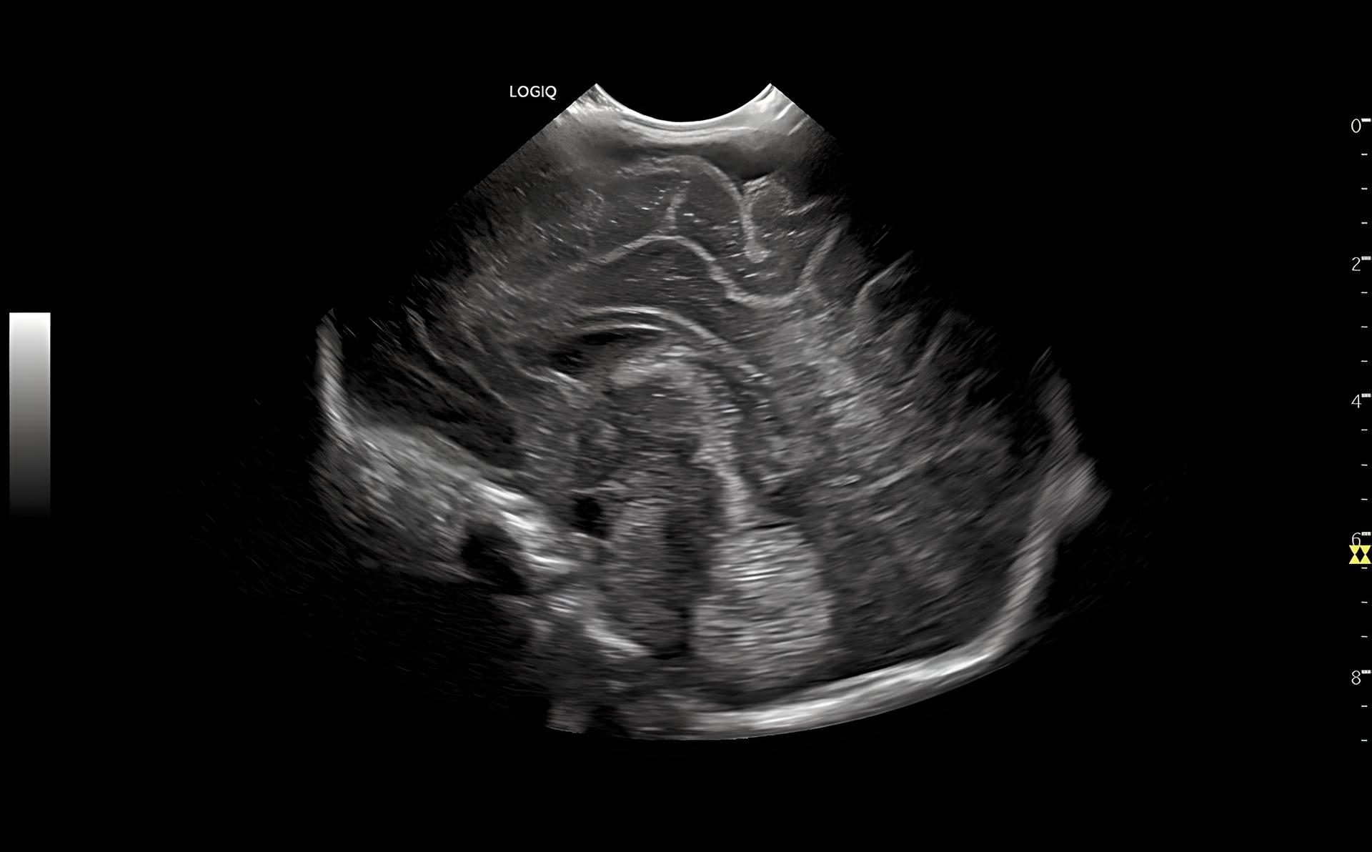 Neonatal Head B-Mode, C3-10-D
Неонаталогія, голова, датчик C3-10-D.
