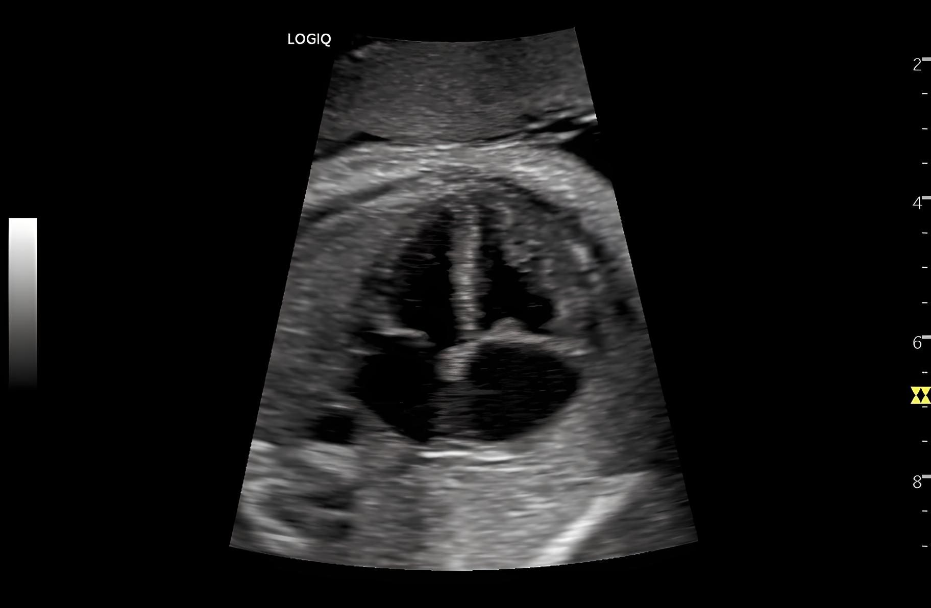 Obstetric 4CH B-Mode, C1-6-D
Серце плода, датчик C1-6-D.
