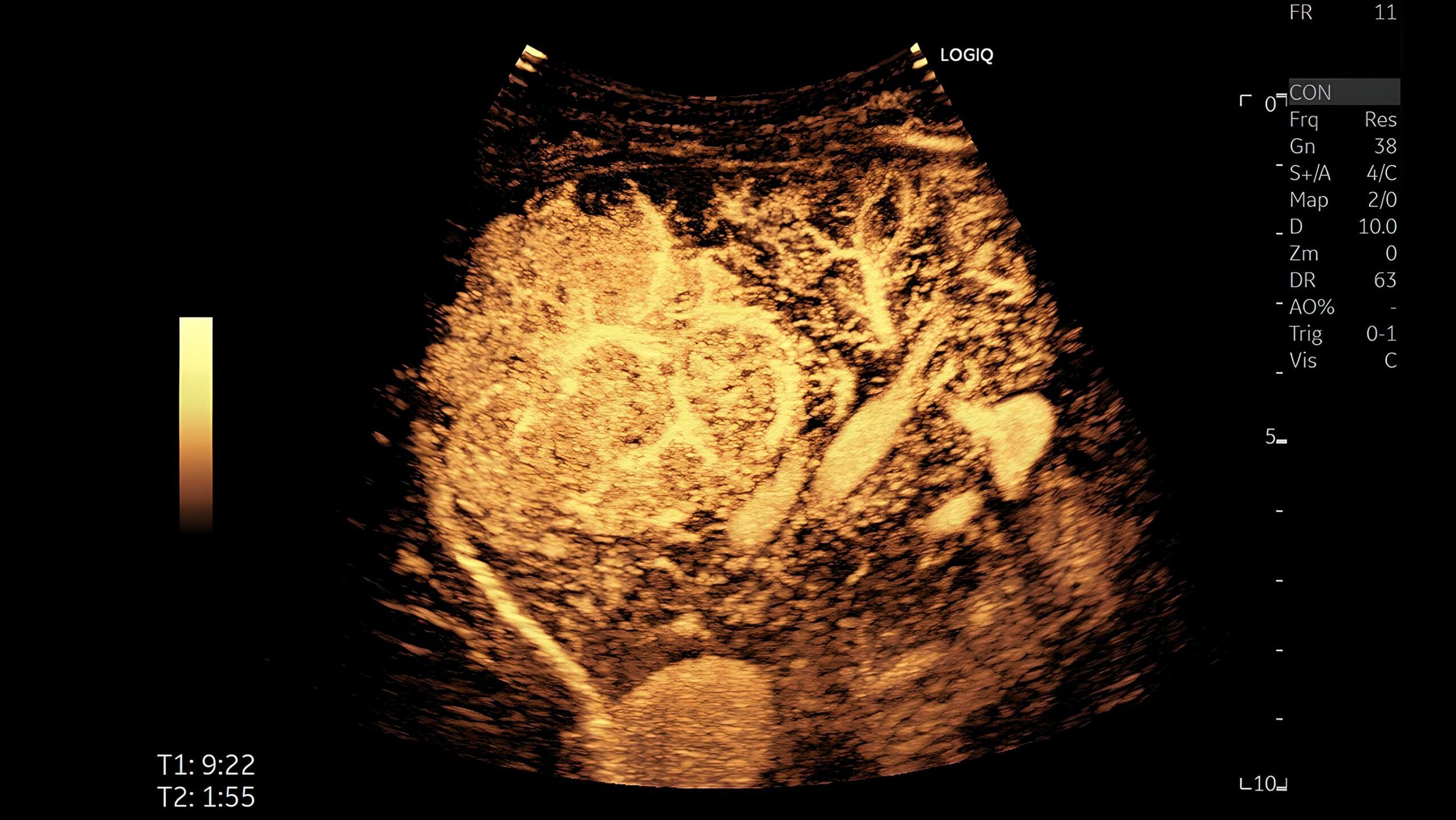 Contrast enhansed imaging, C1-6-D
Дослідження печінки з контрастним підсиленням.
