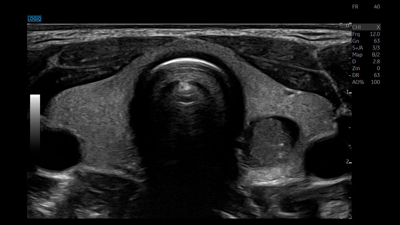 Thyroid, Advanced SRI, ML6-15
Щитоподібна залоза зі застосуванням функції Advanced SRI.
