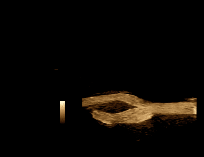 B-Flow™ Imaging