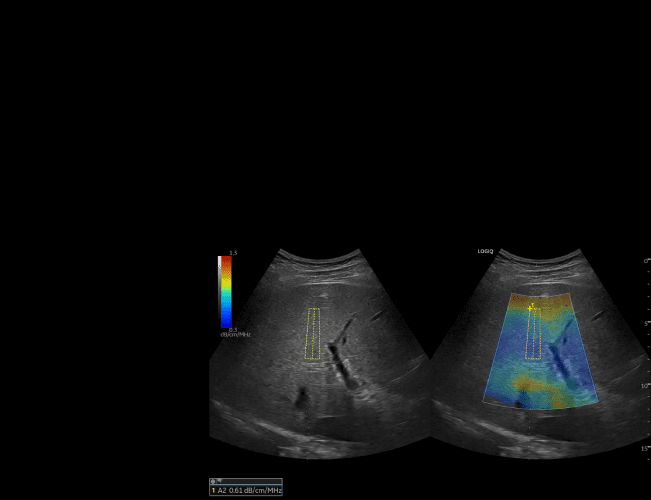 Технологія Ultrasound-Guided Attenuation Parameter (параметр ослаблення ультразвука UGAP) 