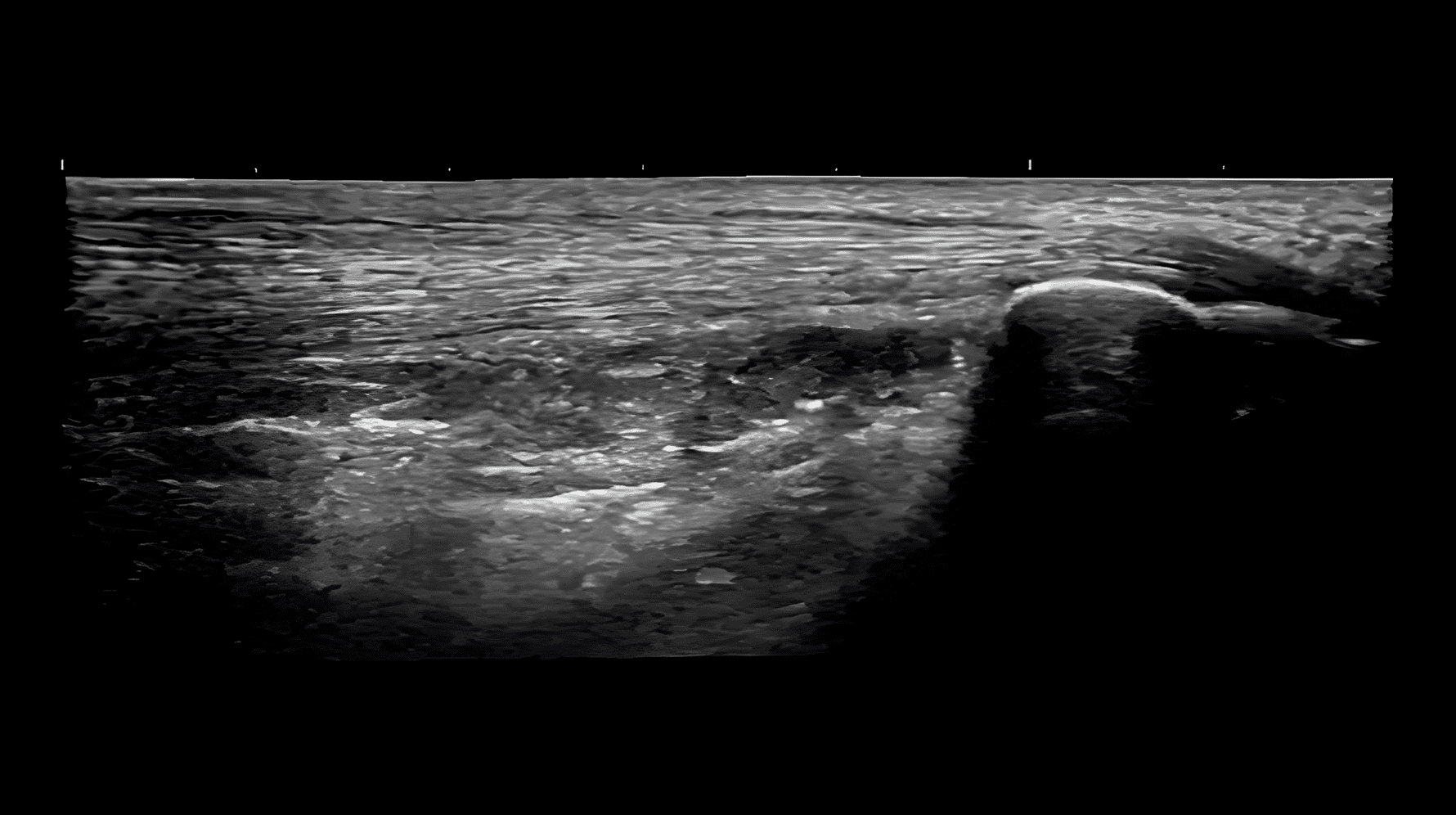 LOGIQ View – панорамне сканування