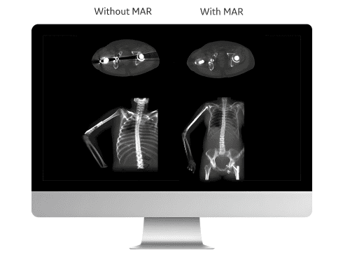 Smart Metal Artifact Reduction (MAR) 
Покращує якість зображення при наявності у пацієнта металевих конструкцій, наприклад, протеза кульшового суглоба або зубних імплантатів.
