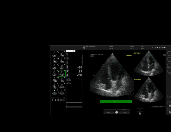 Функція Auto Ejection Fraction