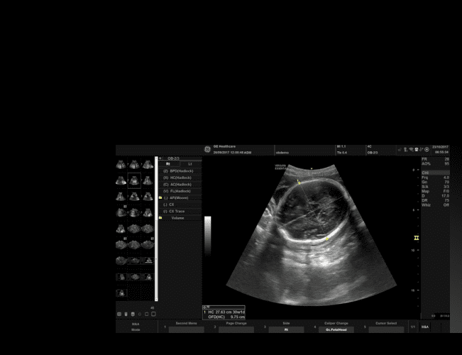 SonoBiometry