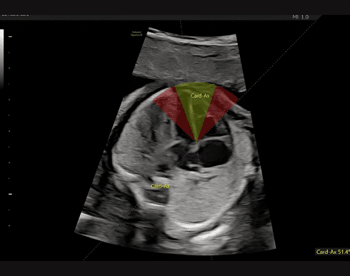 Функція Fetal HS™
Спрощує оцінку серця плода, надаючи поетапний алгоритм, який використовує штучний інтелект для визначення положення плода та нормальної анатомії серця плода за допомогою зображень чотирьох камер серця, трьох судин та вісі серця.
