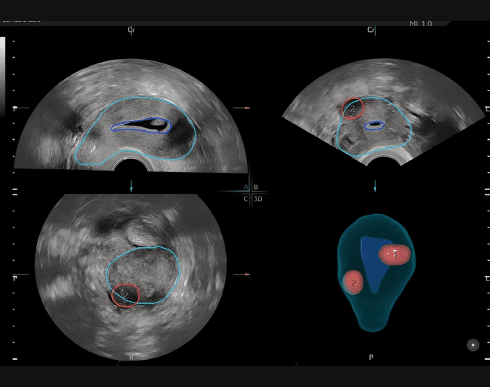 Функція SonoGYN
SonoGYN
Комбінує наш інструмент Uterine Trace та функцію Fibroid Mapping для створення звітів за допомогою штучного інтелекту, з картуванням міоми в 3D.
