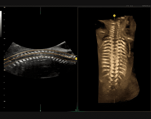 Spine Trace
Просо та легко отримуйте складні 3D зрізи. Просто намалюйте хребет, і система автоматично створить коронарний зріз.
