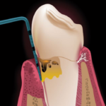 Градуйовані пародонтальні зонди з титану для імплантатів 01(32)