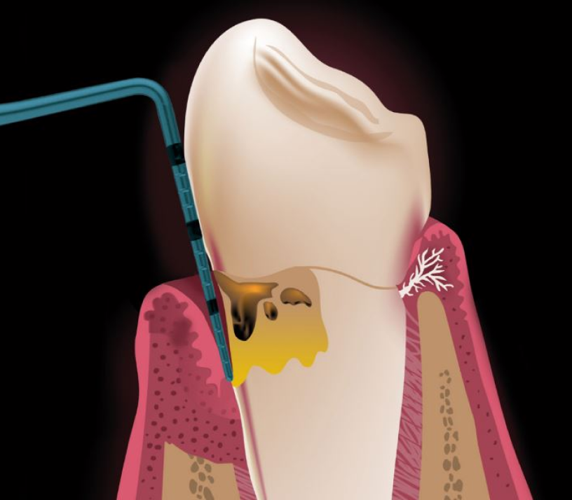 Градуйовані пародонтальні зонди з титану для імплантатів 01(32)